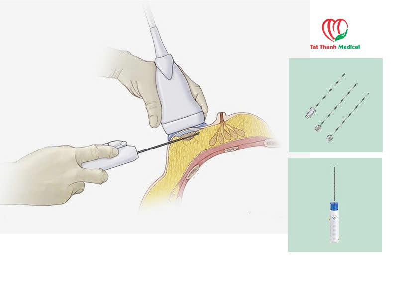Kim sinh thiết - Chìa khóa vàng trong chẩn đoán ung thư