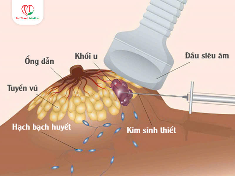 Kim sinh thiết lõi: Công cụ then chốt giúp chẩn đoán chính xác khối u