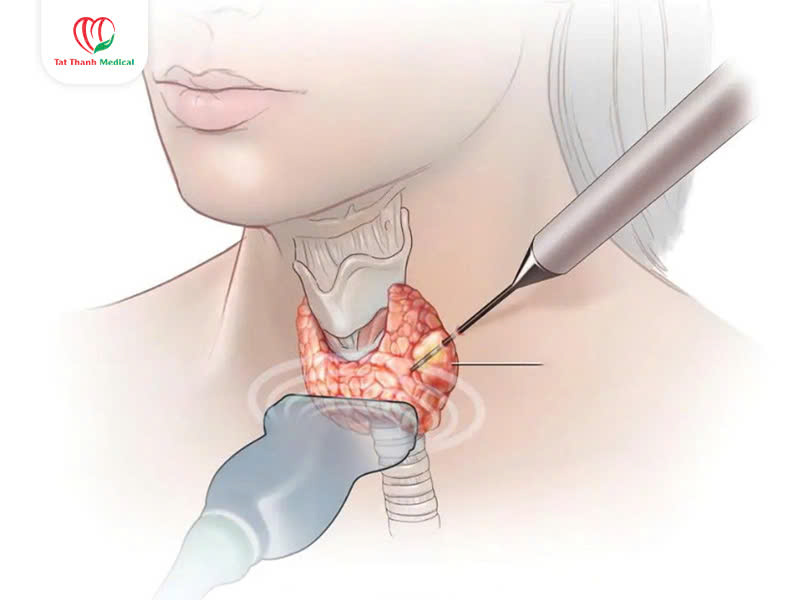 Máy đốt sóng cao tần u tuyến giáp – Giải pháp điều trị tiên tiến cho bệnh viện và phòng khám