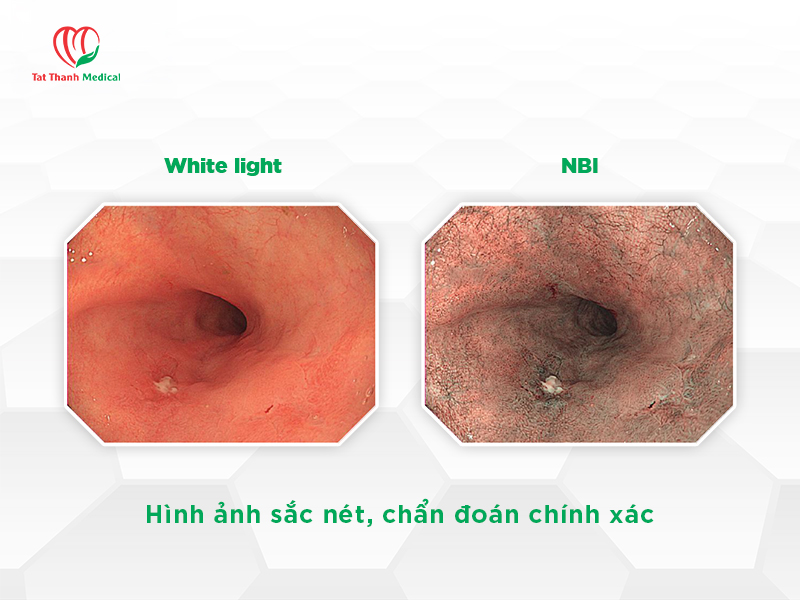 Nội soi phát hiện sớm ung thư đại trực tràng