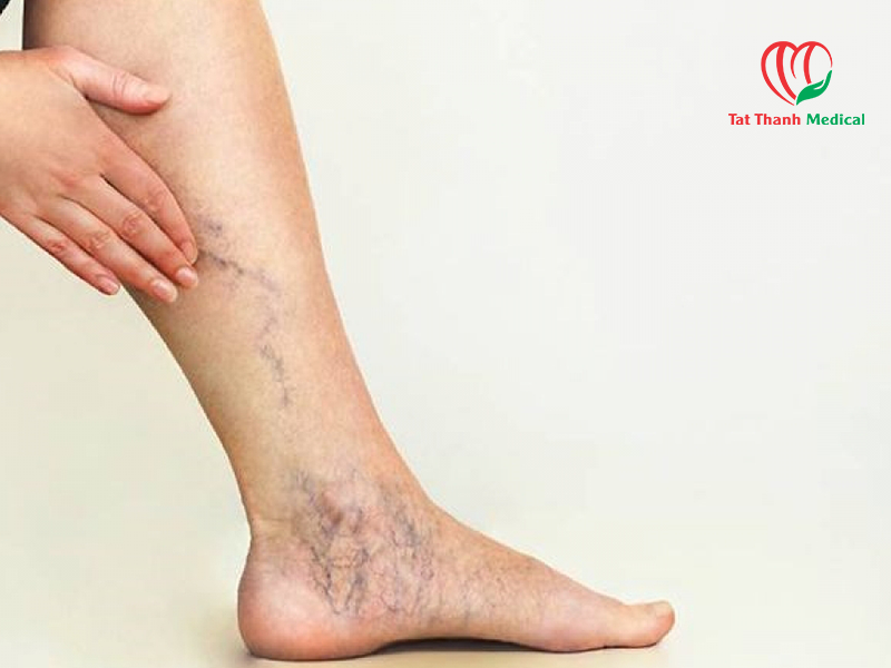 RFA điều trị giãn tĩnh mạch: Xu hướng công nghệ mới đang dần thay thế laser nội tĩnh mạch